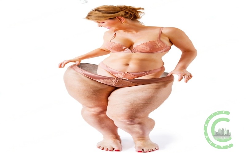 What can you never do after gastric sleeve?