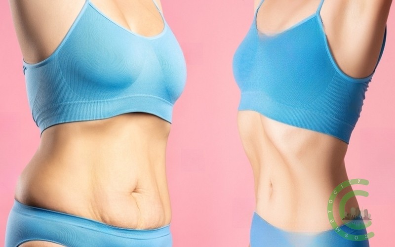 How painful is a tummy tuck?