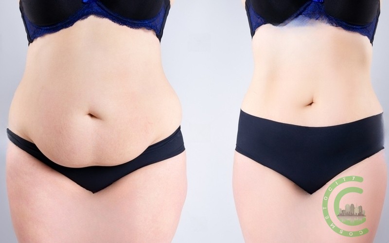 Will my stomach ever be flat after tummy tuck?