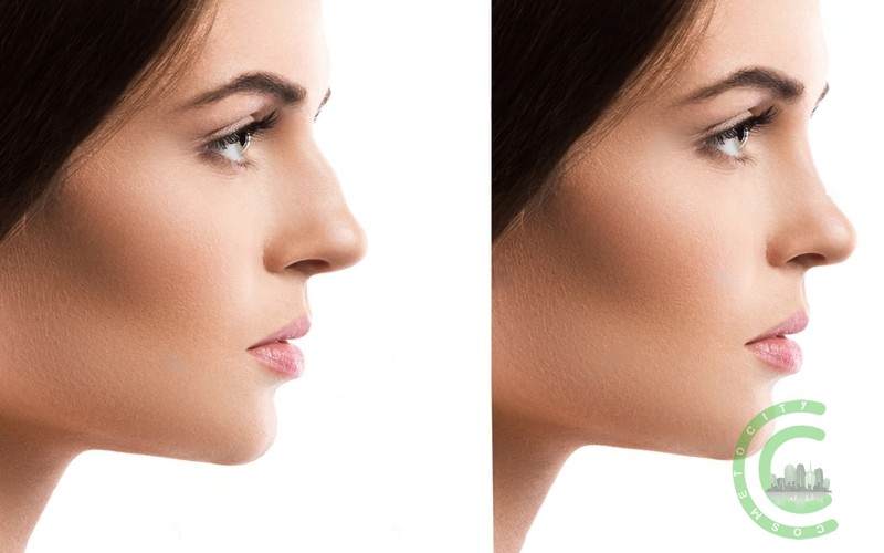 What is the side effect of rhinoplasty?