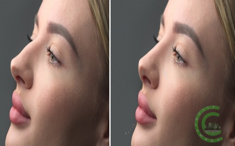 How long should you stay home after rhinoplasty?