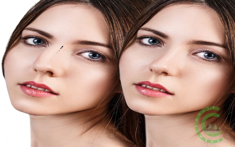Can you still smell after rhinoplasty?