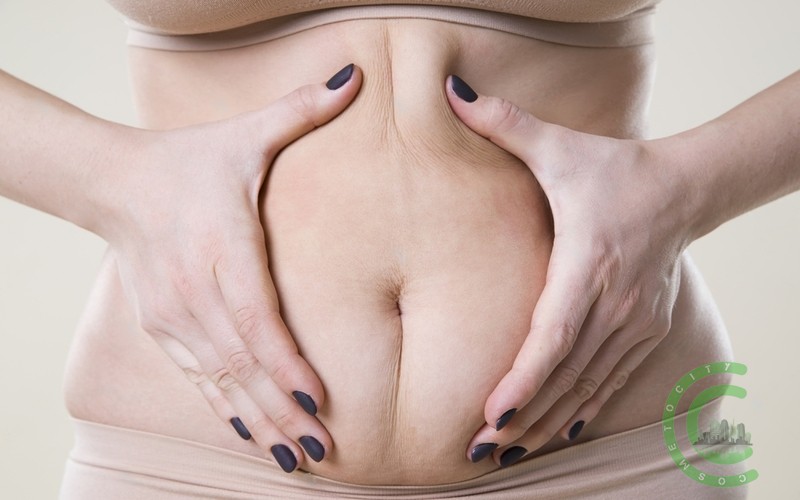 How do I keep my stomach flat after a tummy tuck?