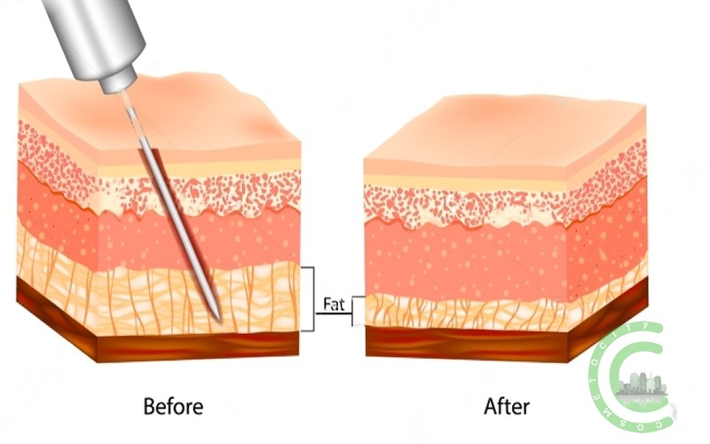 Is liposuction very painful?