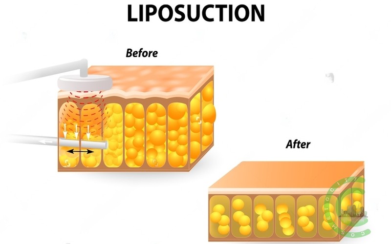 What is the process of liposuction surgery?