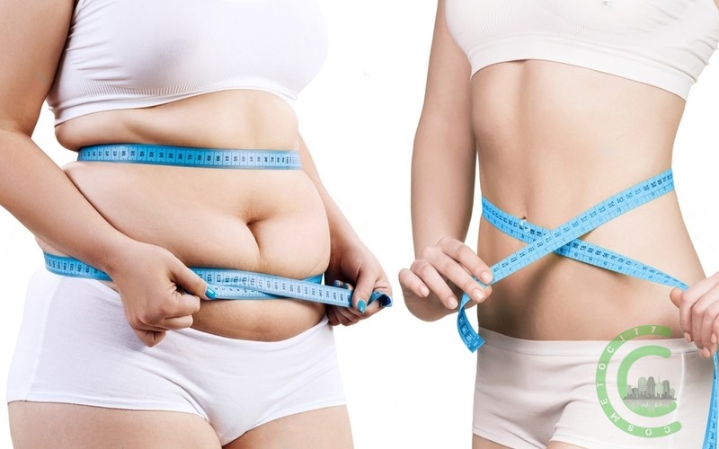 Should I lose weight before liposuction?