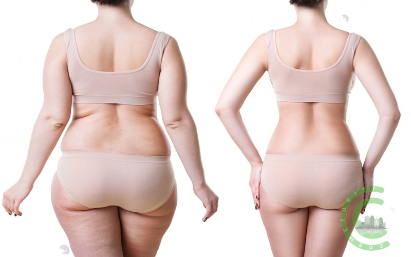 What is a poor diet after lipo?