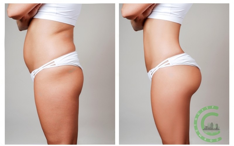 How bad do you feel after liposuction?