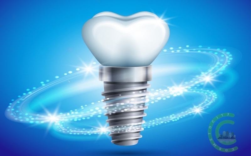 Zahnimplantate: Was Sie wissen müssen