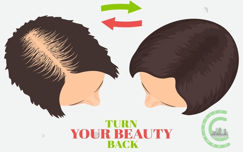 Die Vor- und Nachteile der Haartransplantation