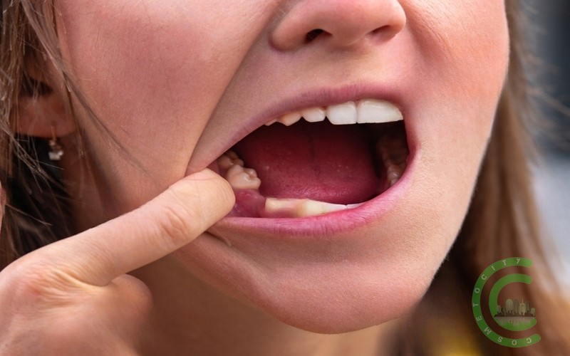 Was dürfen Sie mit Zahnimplantaten nicht essen?