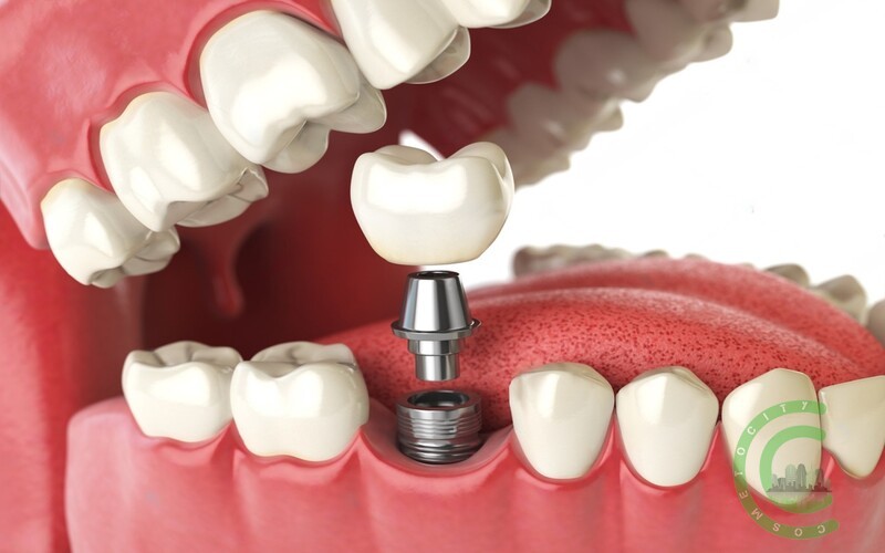 Wie lange bleiben Nähte bei Zahnimplantaten haltbar?