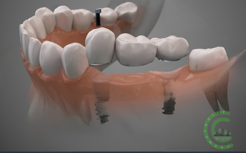Wie lange dauert die Heilung eines Zahnfleisches mit einem Implantat?