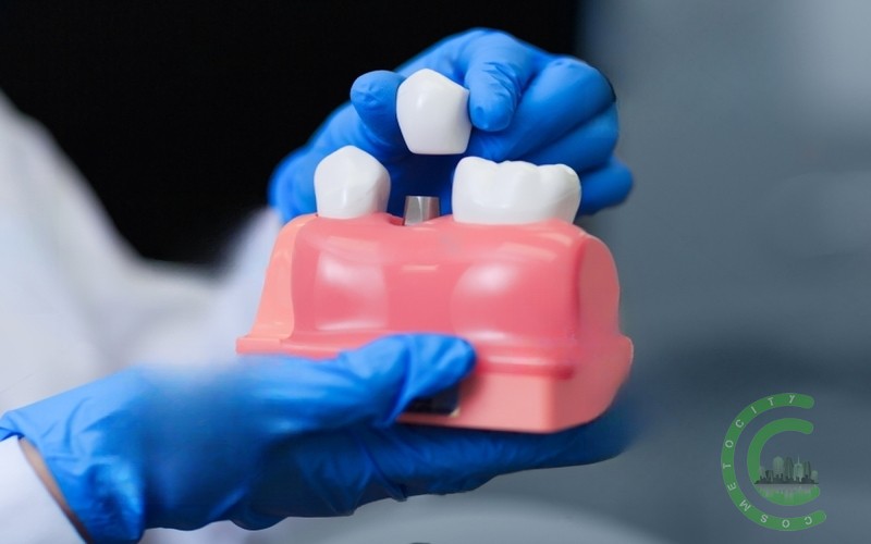 Ist ein Zahnimplantat ein kleiner oder ein größerer chirurgischer Eingriff?