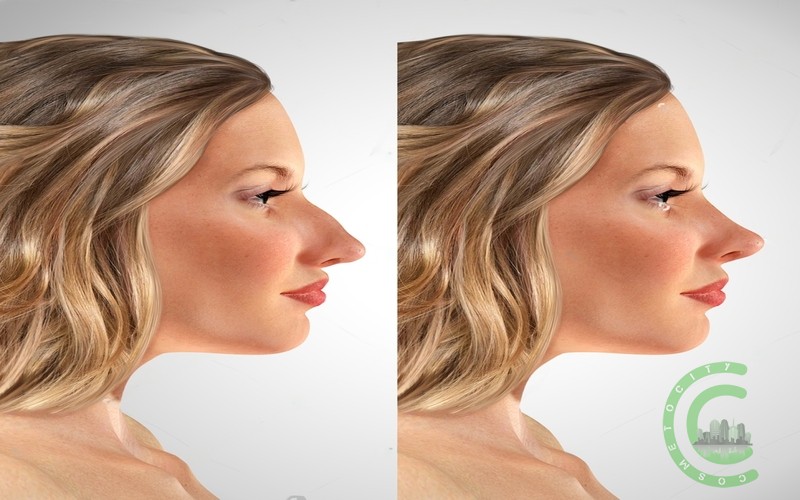 Was passiert, wenn Ihnen Ihre Nase nach einer Nasenkorrektur nicht gefällt?