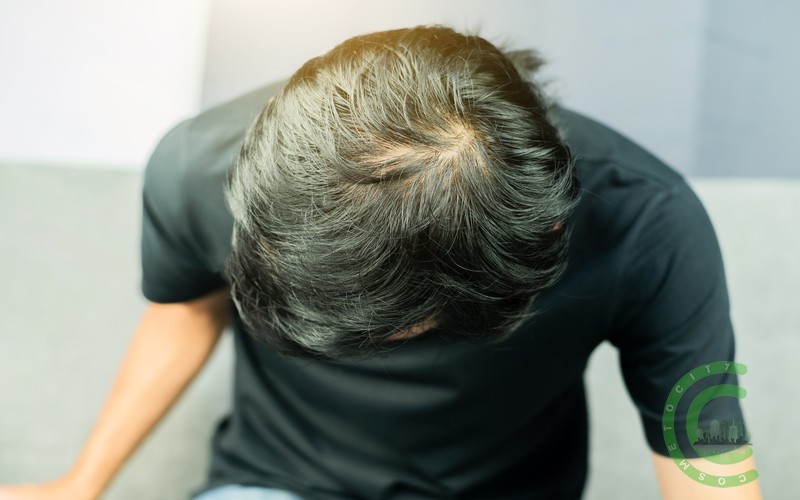 Пересадка волос: постоянное решение проблемы выпадения волос